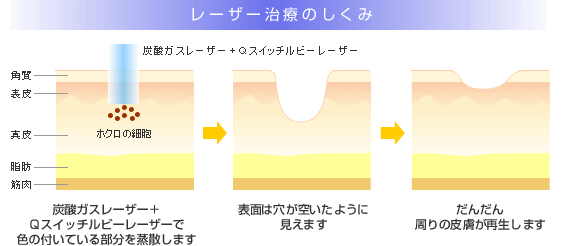 レーザー治療のしくみ