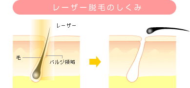 レーザー脱毛のしくみ