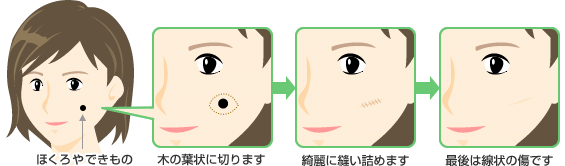 顔のホクロ除去