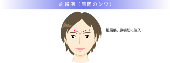 施術例(眉間のシワ)