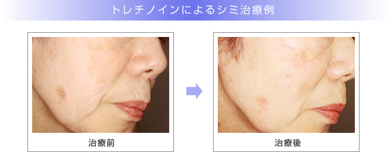 トレチノインによるシミ治療例